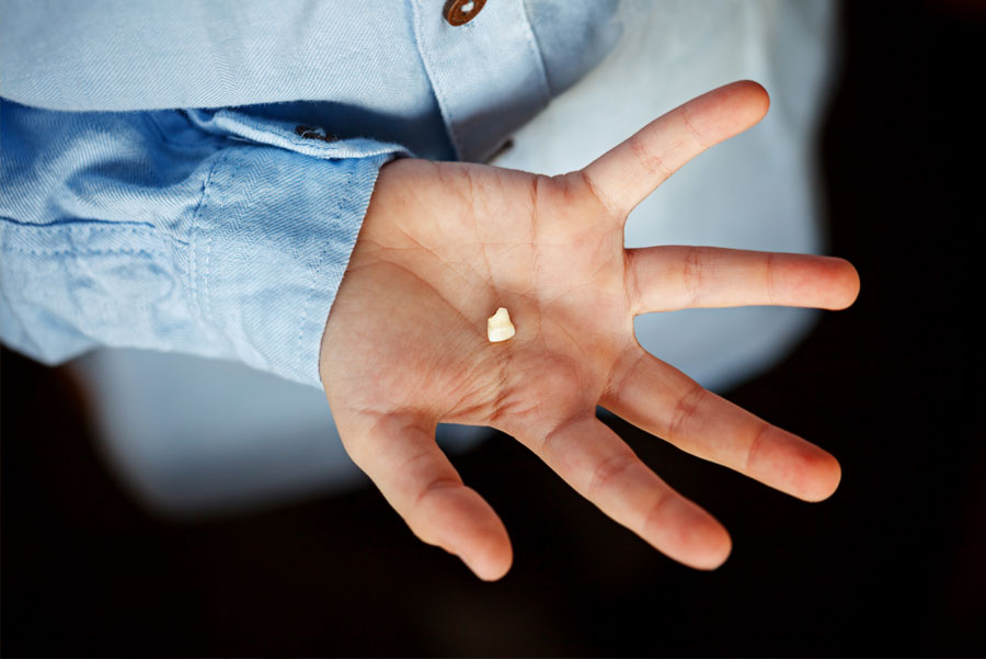 Diente roto por caída