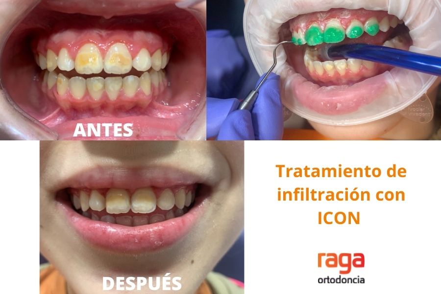 hipoplasia infantil