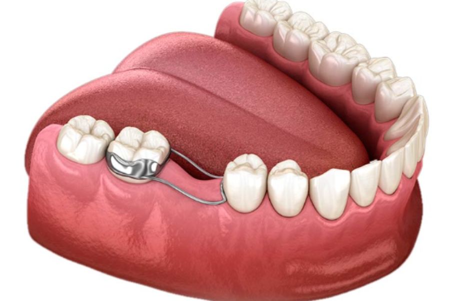 mantenedor de espacio