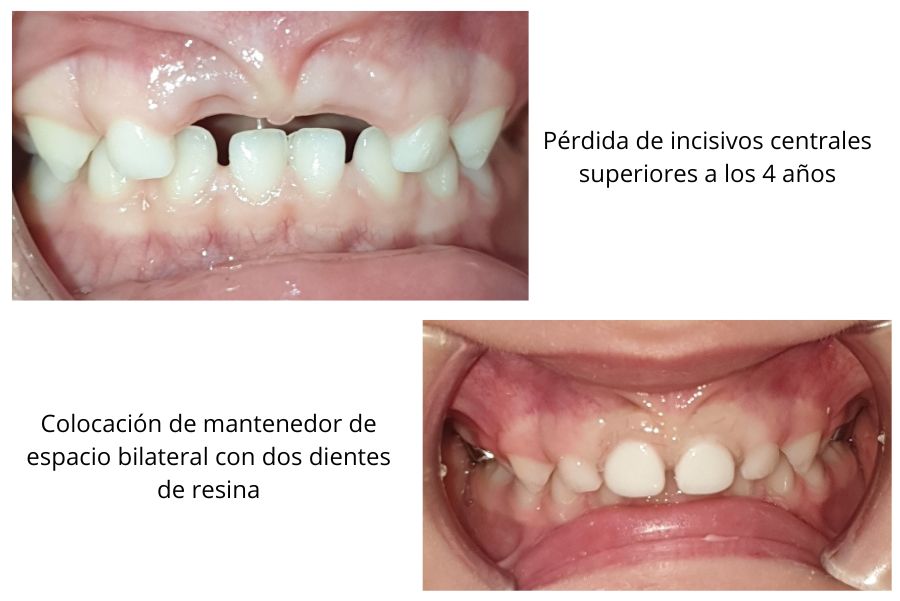 mantenedor de espacio