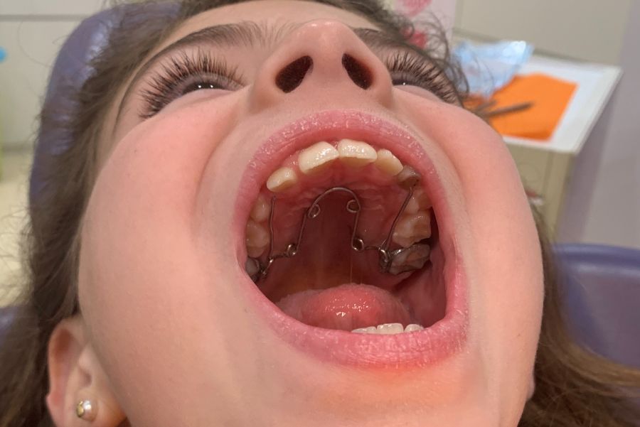 ortodoncia en dos fases