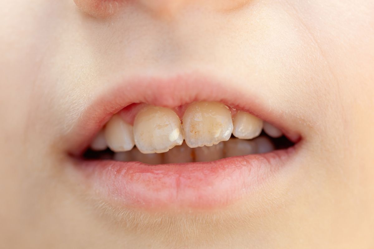 fluorosis-dental-niños