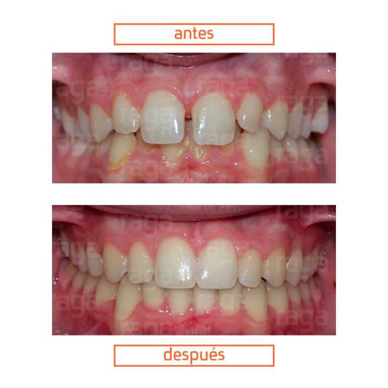 caso-clinico-ortodoncia-invisible-adolescentes