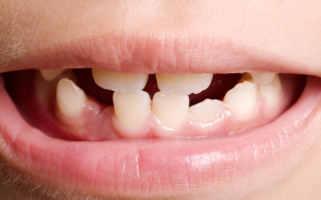 agenesia-dental