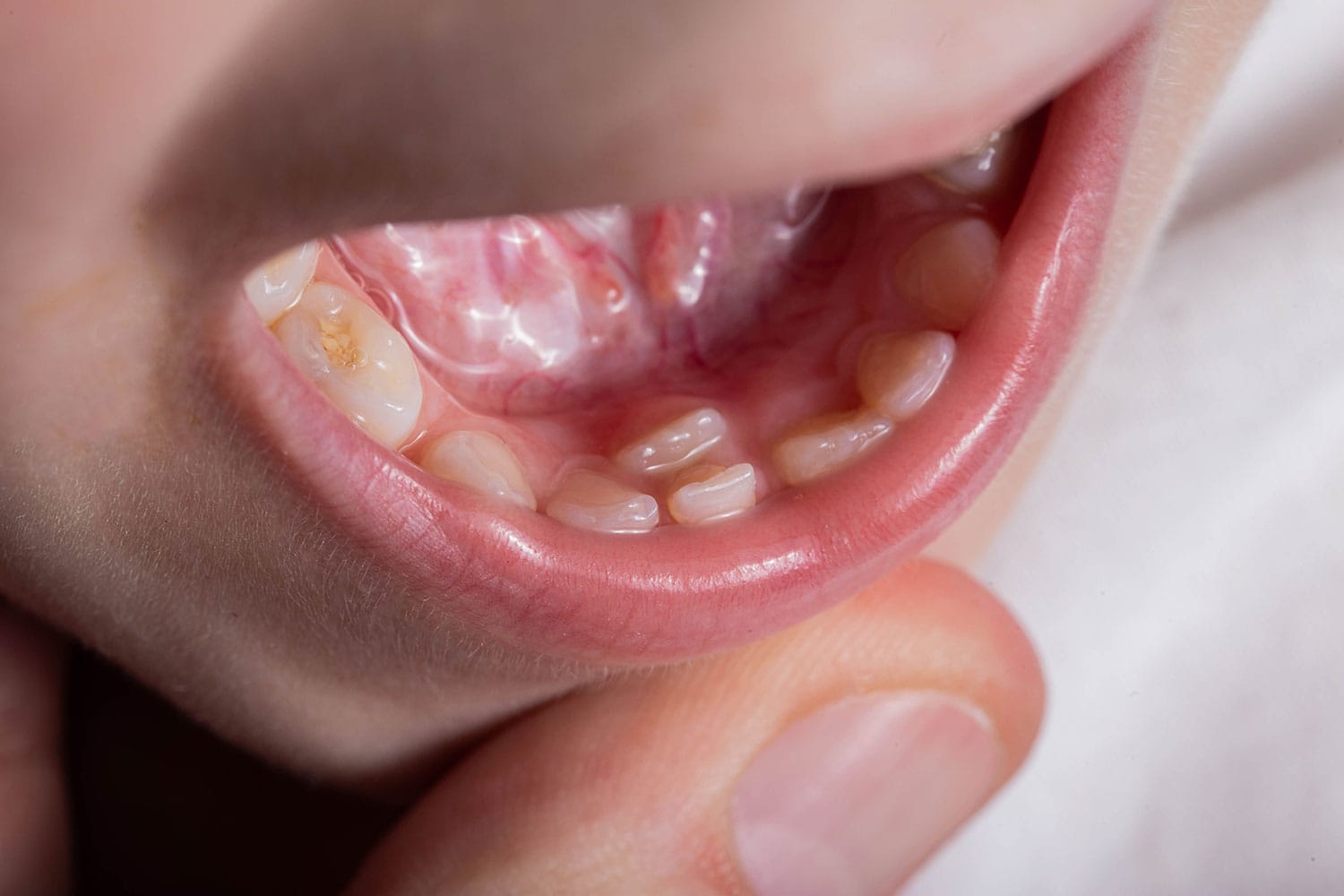 aparicion-denticion-permanente