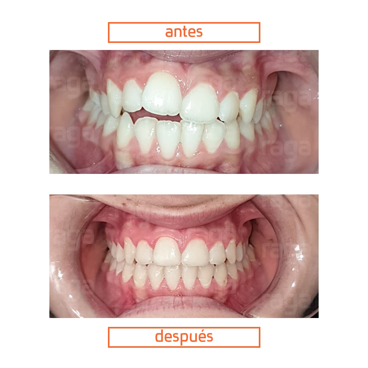 brackets-adolescente-raga-valencia