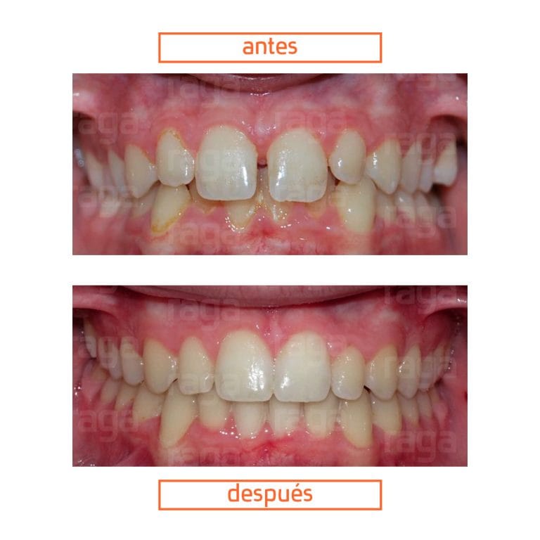 caso-clinico-ortodoncia-invisible-adolescentes