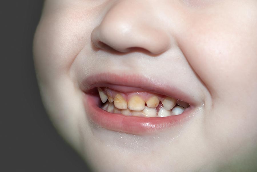 Solución para los dientes amarillos en niños
